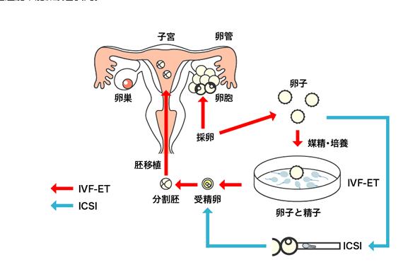 供卵一般做的几代试管_几代供卵试管技术的突破与应用